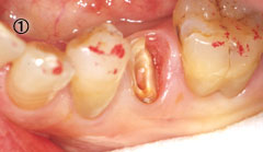 歯牙挺出 治療の流れ1