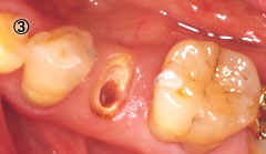 歯牙挺出 治療の流れ3